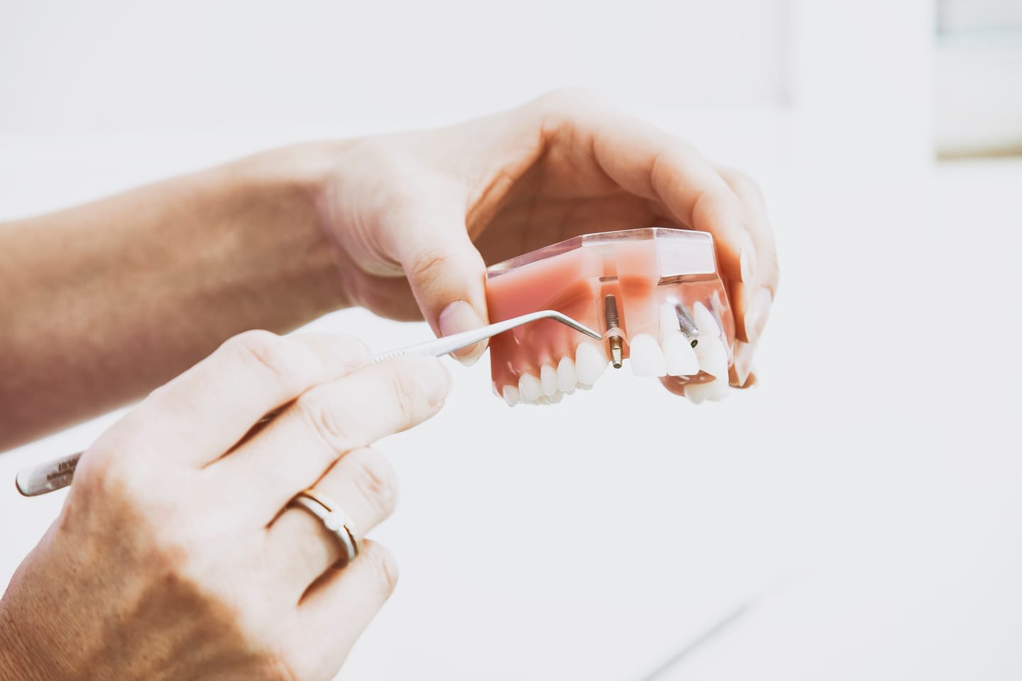 Hands holding a model of an upper jaw with two dental implant screws and a dental probe