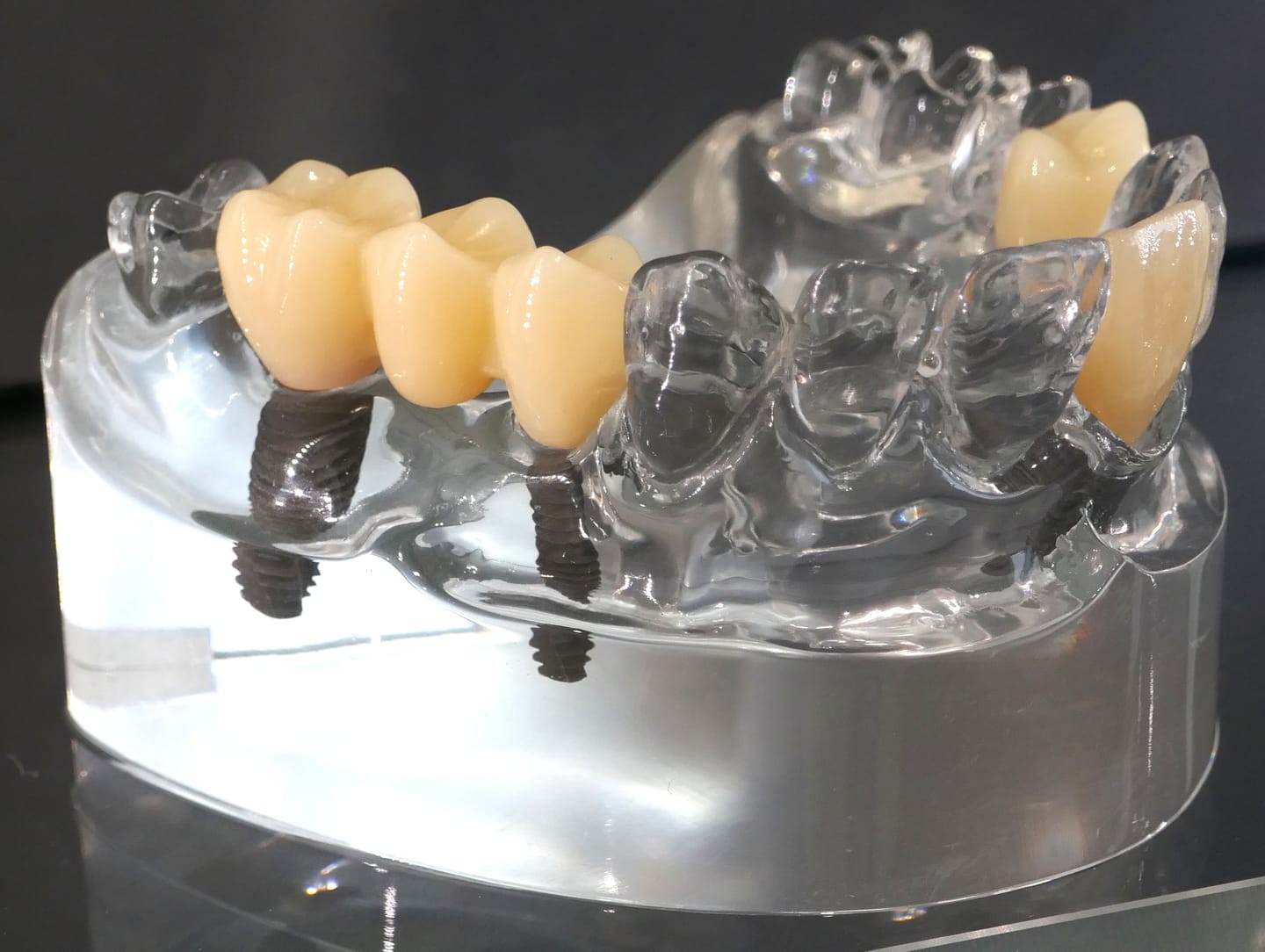 A clear teaching model of a lower jaw showing implant screws below a bridge of three crowns