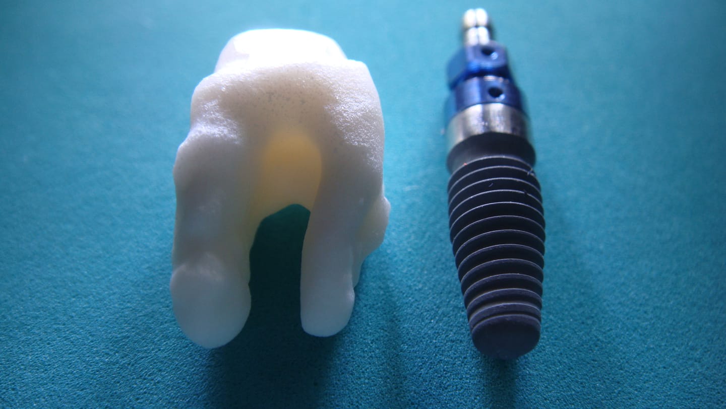 Ein keramisches Wurzelanalog-Zahnimplantat neben einem Schrauben-Implantat aus Titan zum Vergleich
