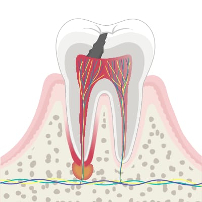 Querschnitt eines Backenzahns mit Karies, die bis ins Dentin und zum Nerv reicht, als Schema zum Fortschreiten von Karies