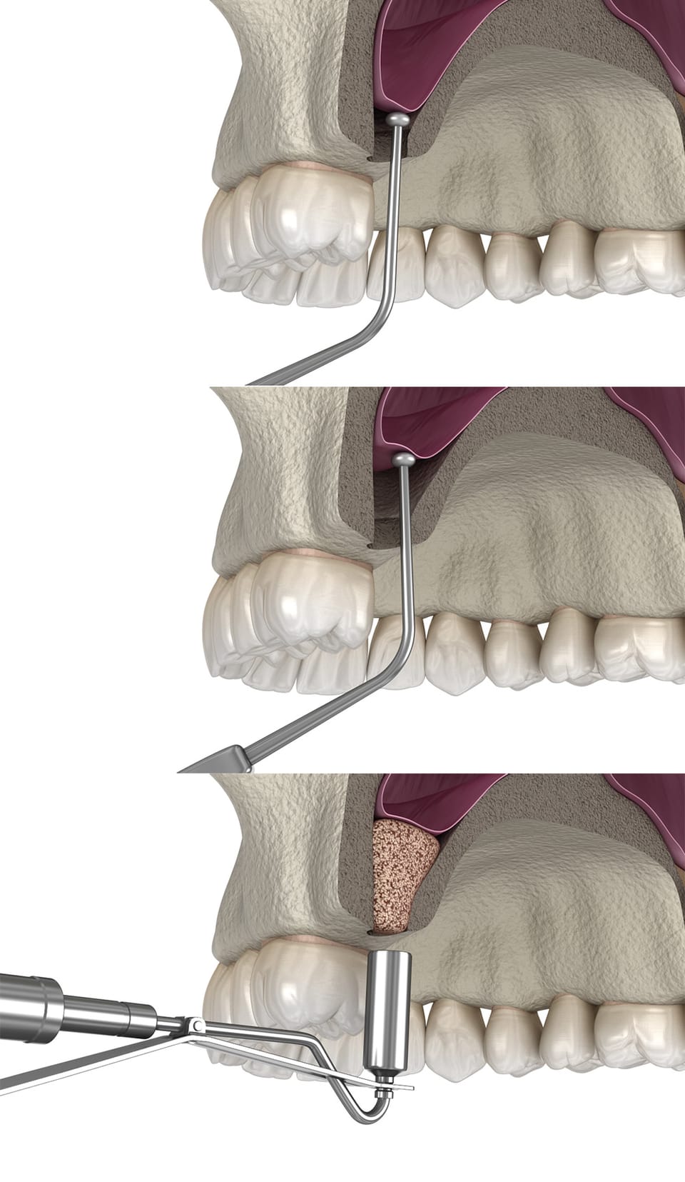 Dreistufige Illustration eines Sinuslifts: Knochen eröffnen, Kieferhöhlenschleimhaut anheben, Knochenersatzmaterial einbringen