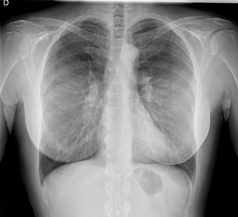 Frontal chest X-ray showing breast implants as outlines over the lower chest
