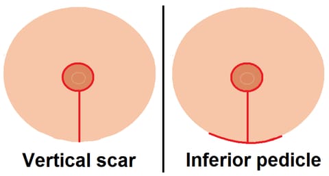 Diagram of breast reduction techniques showing a vertical scar pattern and an inferior pedicle pattern