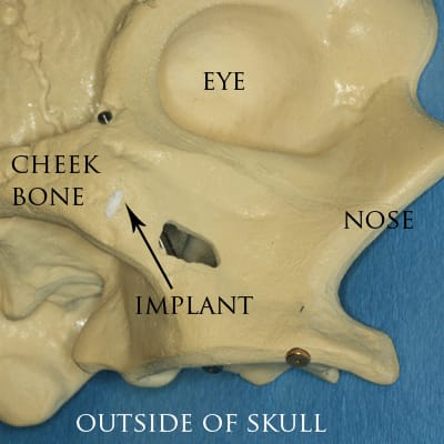 Anatomical skull model showing the position of a zygomatic implant anchored in the cheek bone