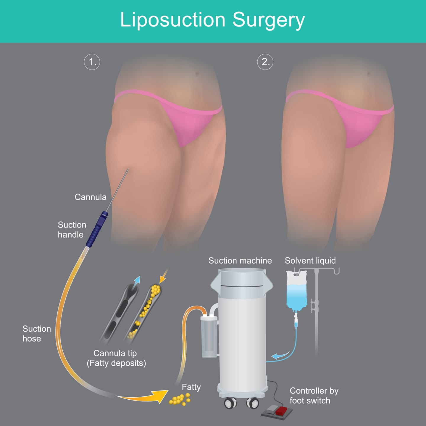 Illustrated diagram of liposuction showing a cannula, suction hose and suction machine, before and after