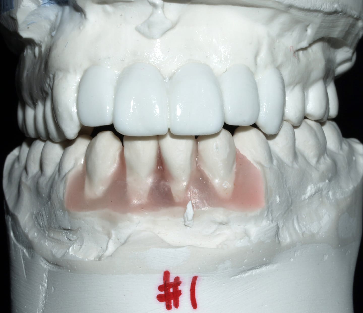 Plaster dental model showing a fixed prosthetic tooth bridge on the upper arch and a removable prosthesis below