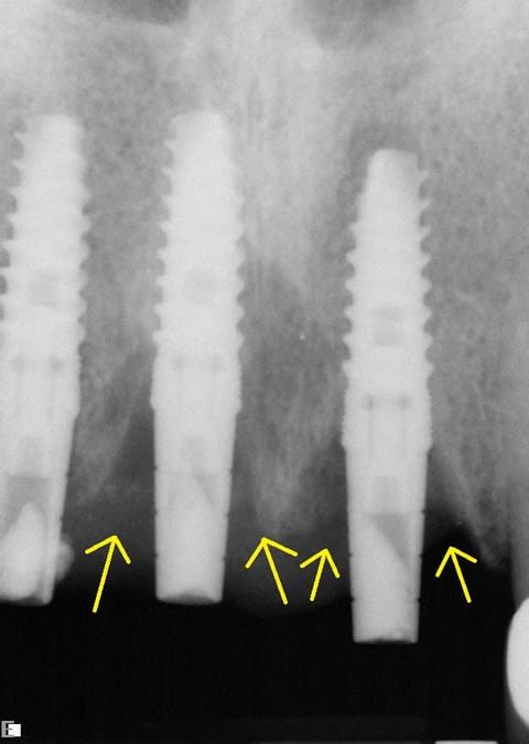 Dental X-ray showing three titanium implant screws in the upper jaw with bone loss marked by arrows