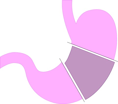 Diagram of a stomach with the part removed in a sleeve gastrectomy shaded